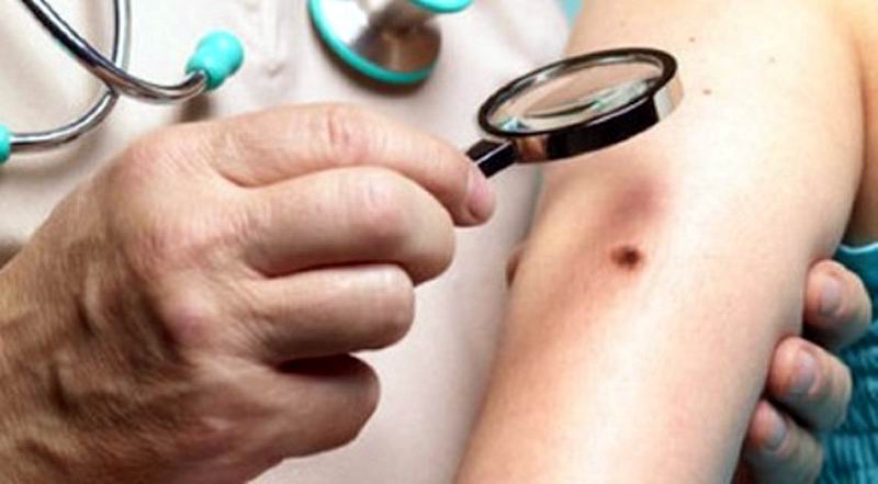 En Audio La Lepra No Es Un Problema De Salud En Cuba