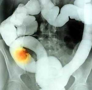 Extenderán pruebas para diagnóstico de cáncer de colon