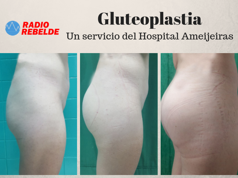 Gluteoplastia: un servicio del hospital Hermanos Ameijeiras