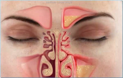 Fuera la congestión nasal en menos de un minuto