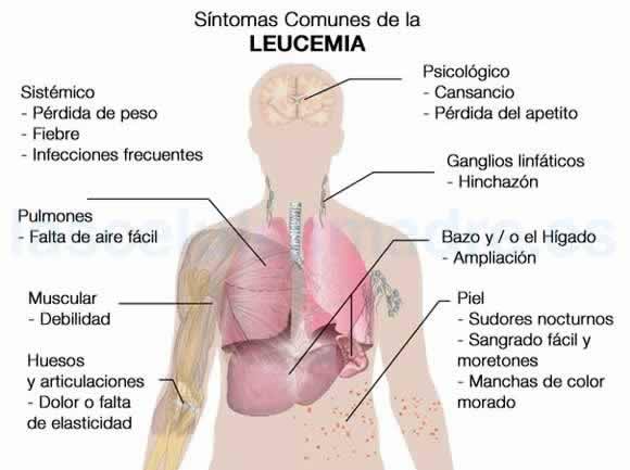 Cifras y consideraciones sobre la leucemia infantil en Cuba 