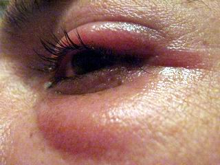 Remedio natural para eliminar los orzuelos