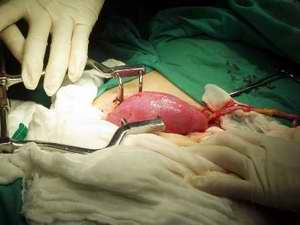 Cuba with over 5 Thousand Kidney Transplants since the 1970s Cuba with over 5 Thousand Kidney Transplants since the 1970s