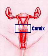 CAUSA DE CANCER DE CUELLO UTERINO causa de cancer de cuello uterino:
