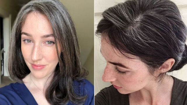 Conozca las causas de las canas en personas jóvenes