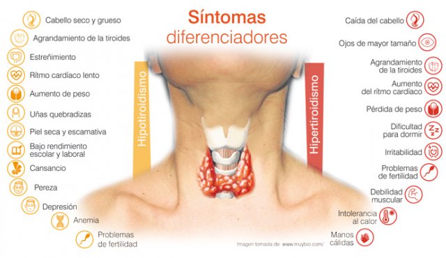 ¿Conoces qué es el hipotiroidismo?