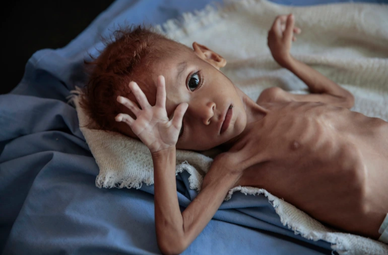 WHO says 75% of Yemeni children are chronically malnourished