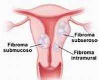 Localización del fibroma
