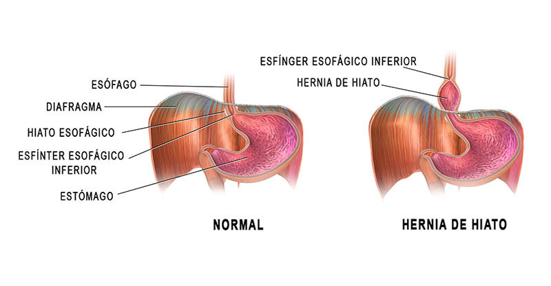 Hernia de hiato inflamada