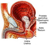 C&aacute;ncer de pr&oacute;stata