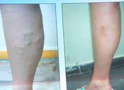 Varices